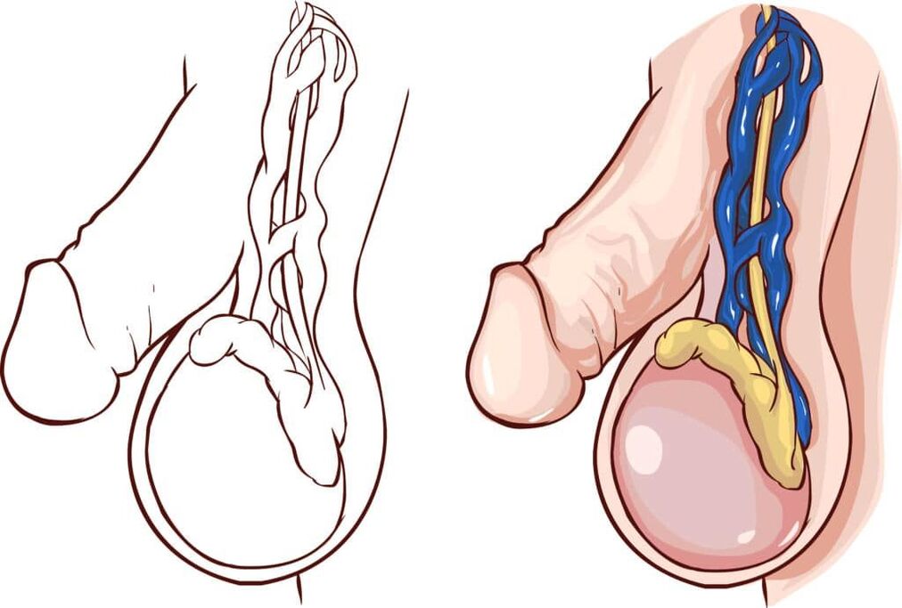 varicocele as a cause of pain in the egg when aroused